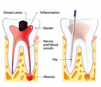 root canals do not hurt