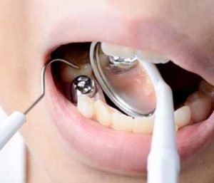 Safe removal techniques of amalgam fillings.