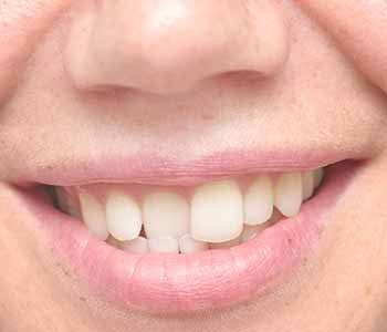 Crooked teeth