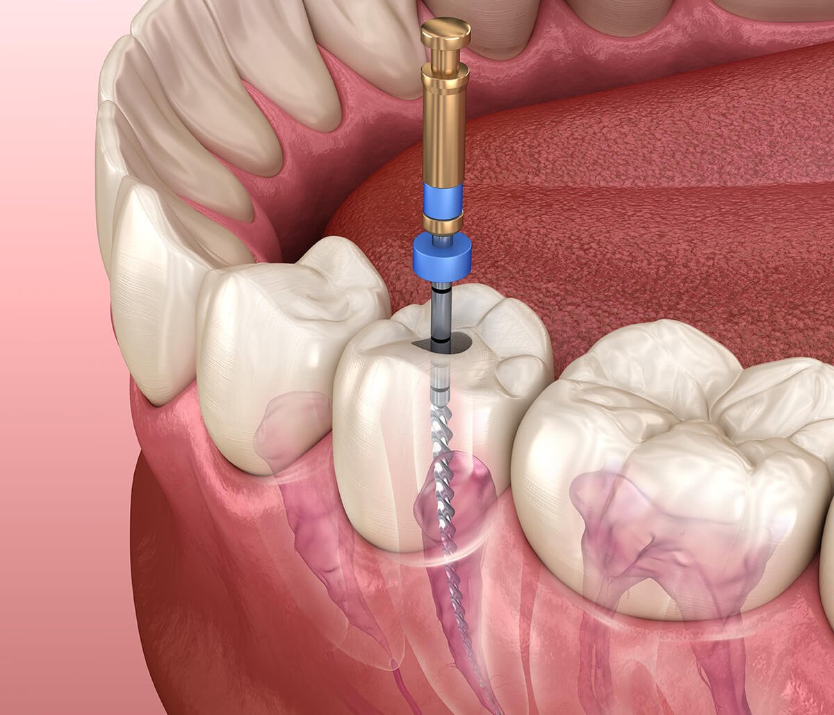 Holistic Root Canal Therapy in Skowhegan ME Area