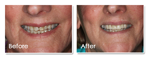 Before and After image of Nonsurgical Periodontal Treatment in Maine ME Area
