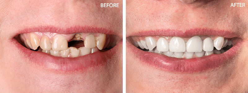 Root Canal Treatment Skowhegan ME - Root Canals