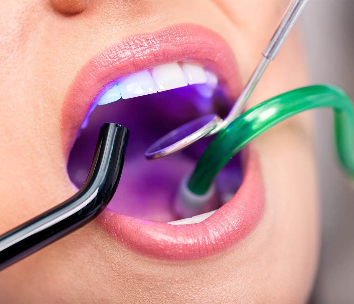 Laser Dentistry Services in Skowhegan ME Area